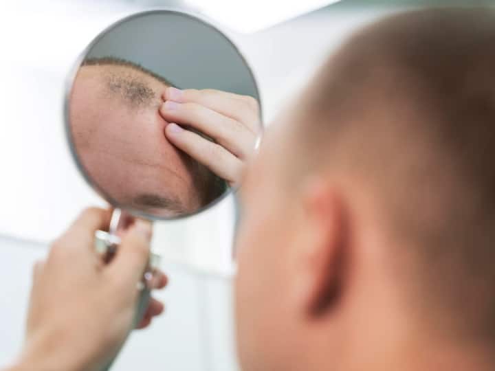 Hair Fall Problem Increases In Men Because Of Sugar Drinks
