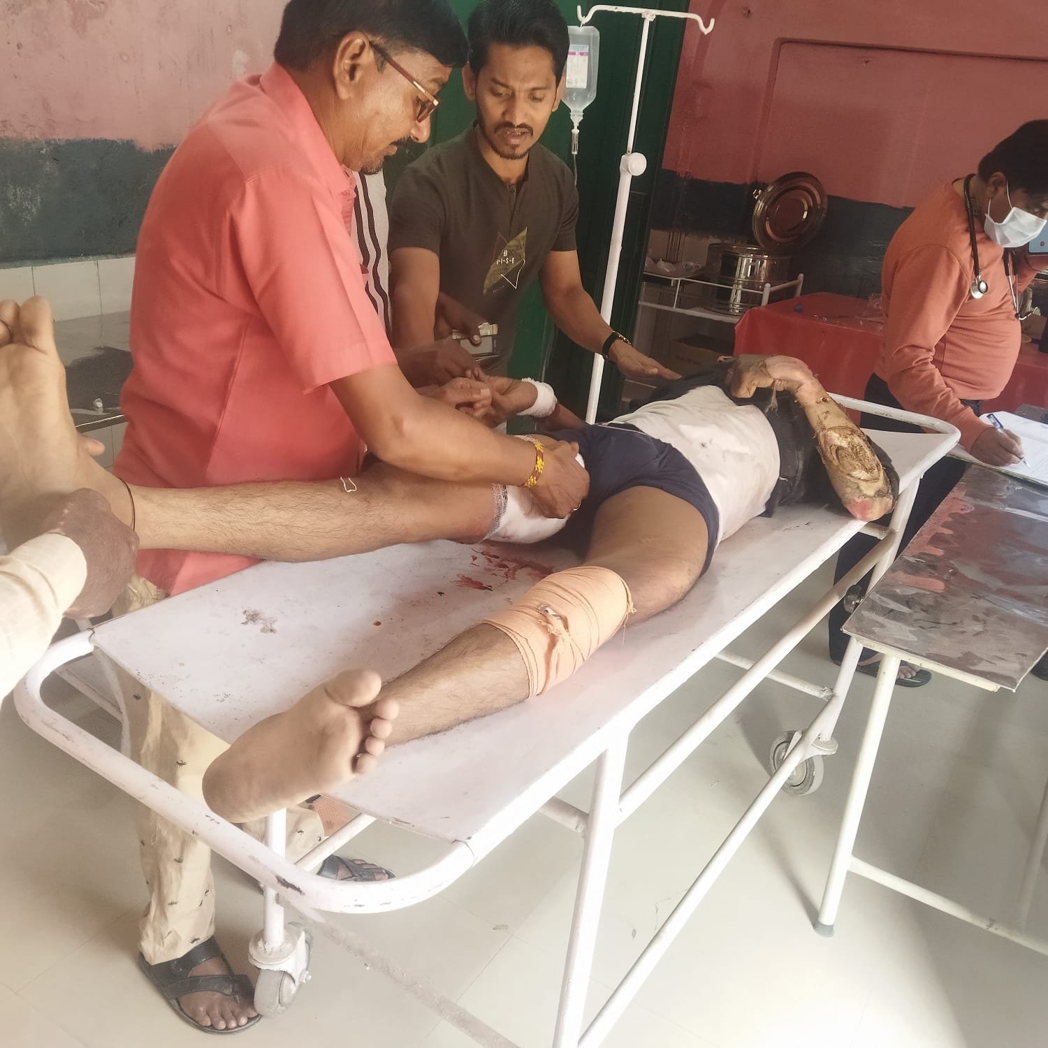 ट्रांसफार्मर में तेल डालते समय प्राइवेट लाइनमैन झुलसा ट्रांसफार्मर में तेल डालते समय प्राइवेट लाइनमैन झुलसा