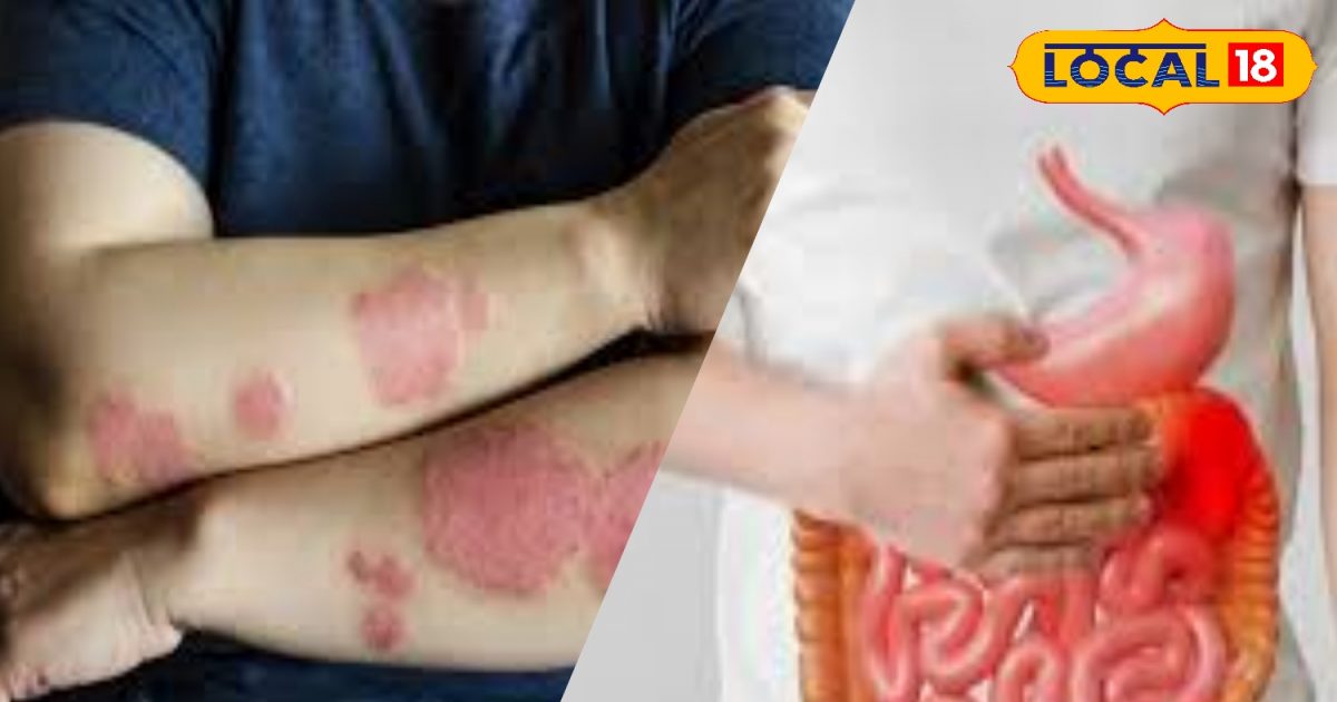 त्वचा पर ऐसे लक्षण पेट की बीमारियों की तरफ करते